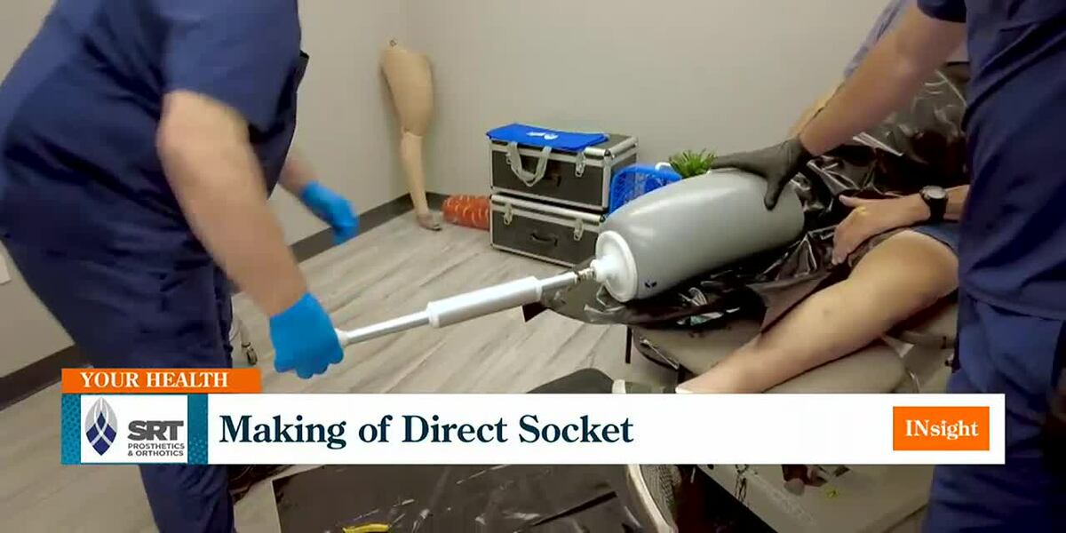 SRT Prosthetics & Orthotics: Making of Direct Socket